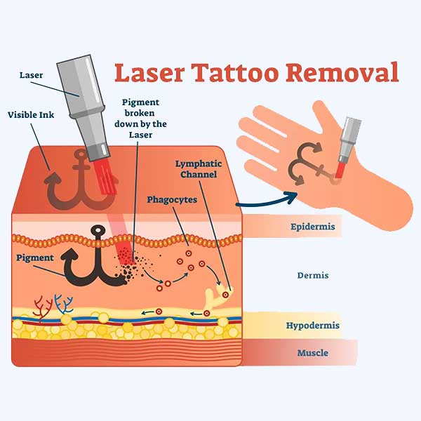 how laser tattoo removal works